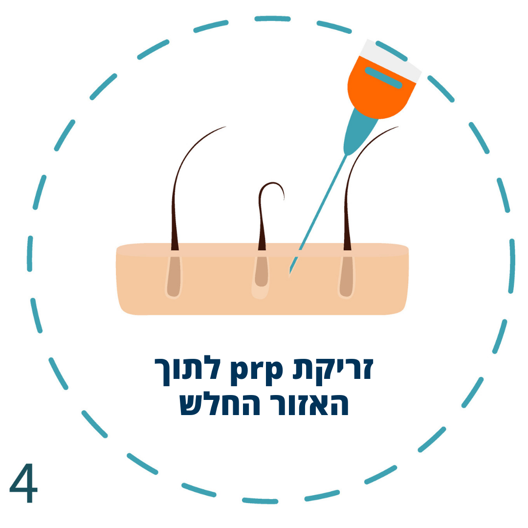 Read more about the article טיפול PRP ו-PRF לטיפול בהתקרחות